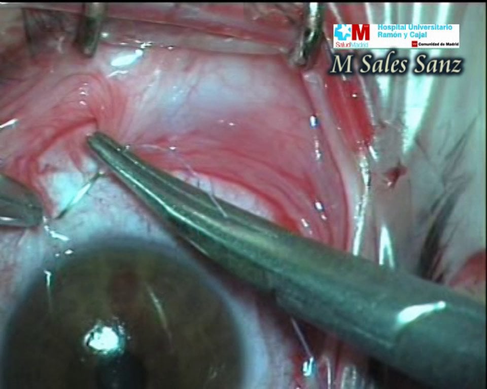 V1-Extracción de hemangioma cavernoso intracónico por abordaje perilímbico