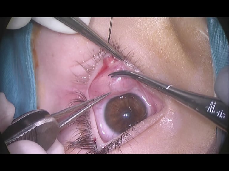 Orbitotomía transconjuntival inferior. Extracción de tumor orbitario extraconal