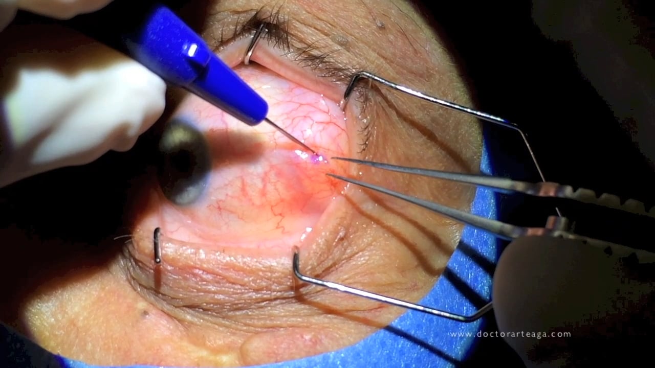 Extracción sin suturas de Hernias Grasas Transconjuntivales