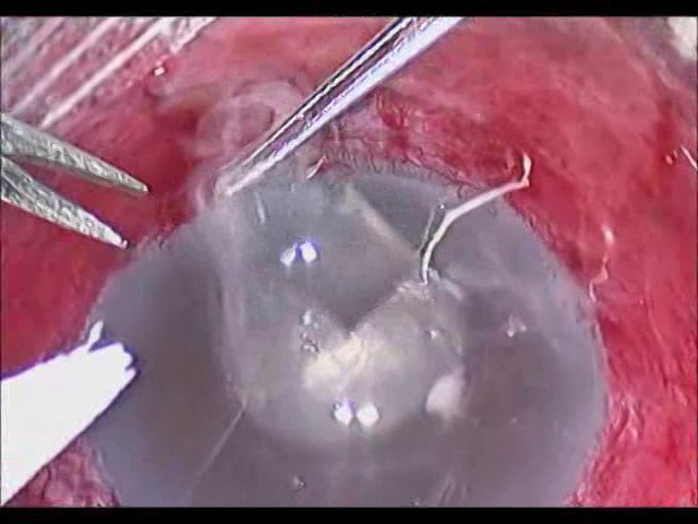 V10-Desprendimiento coroideo masivo por membrana ciclítica post-trabeculectomía