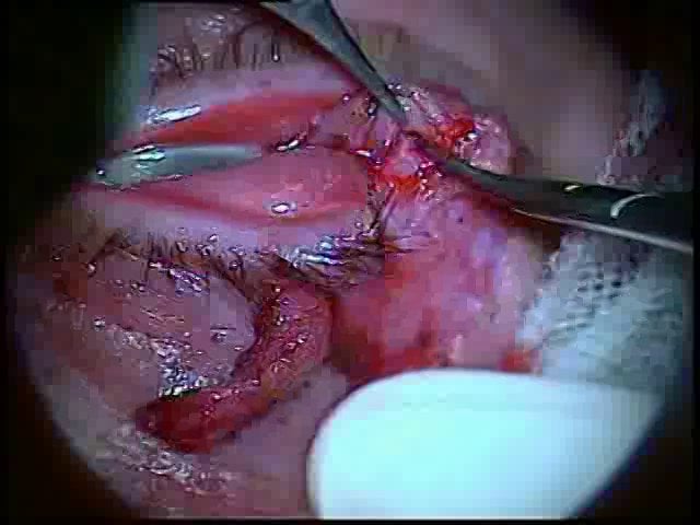 V12-Coloboma con triquiasis a raíz de cirugía de un síndrome del párpado laxo