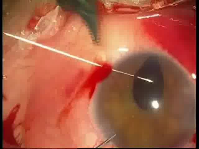 V13-Tratamiento quirúrgico de glaucoma y catarata en paciente con coloboma de iris