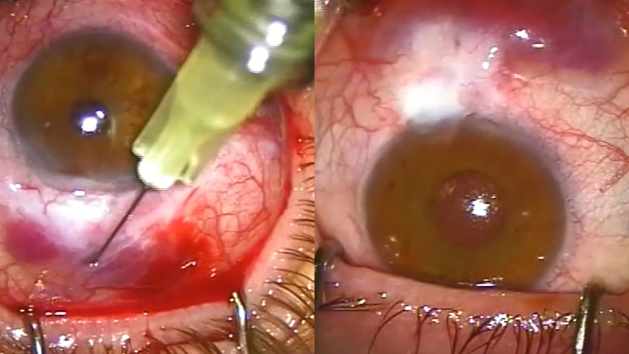 Needling - rescatando la ampolla