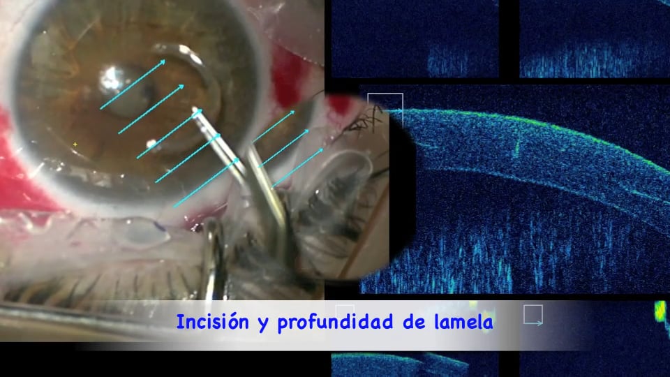 Implantación de Segmentos Intracorneales mediante sistema de OCT intraoperatorio, en tiempo real