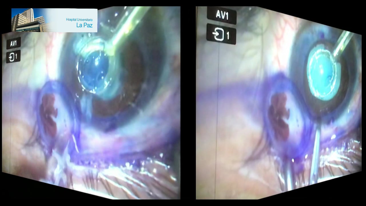 Capsulotomía con ZEPTO a cielo abierto