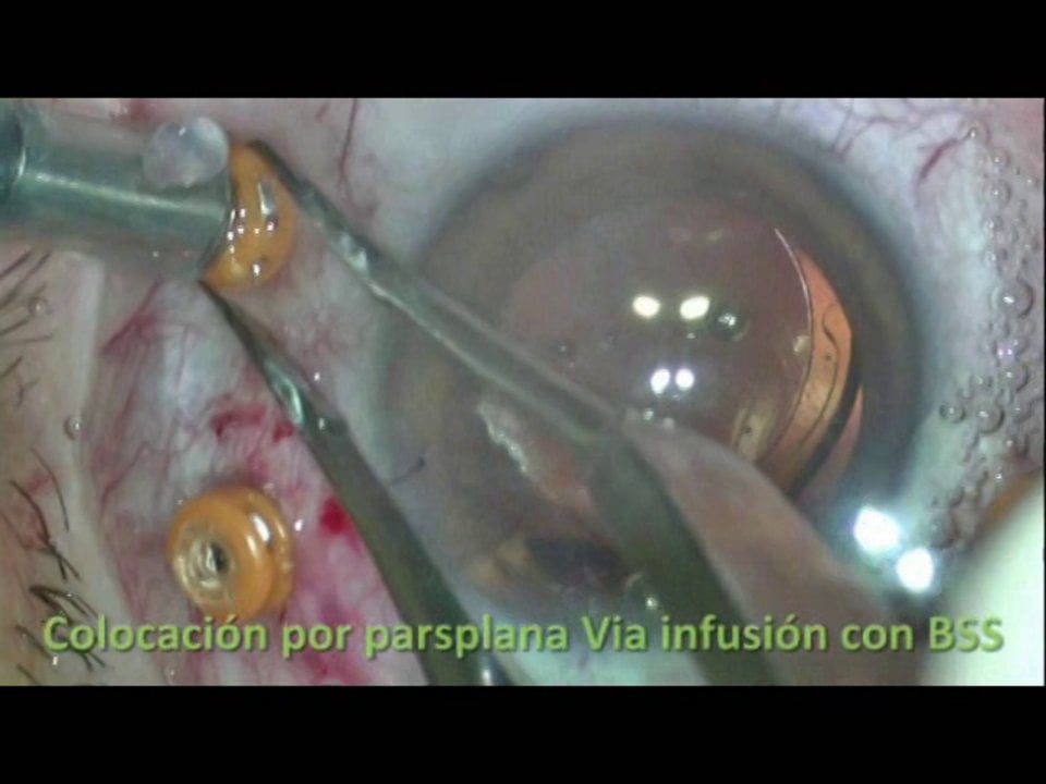 V3-Extracción simultánea de catarata y de aceite de silicona intraocular e implantación de LIO en saco capsular