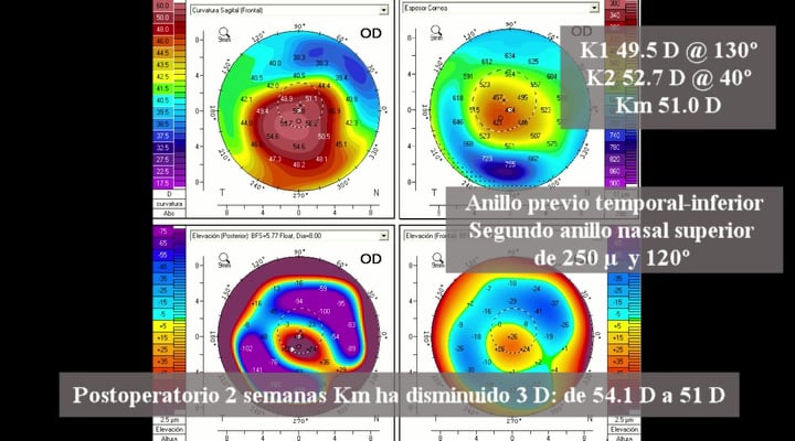 Femtosegundo enmascarado y queratocono