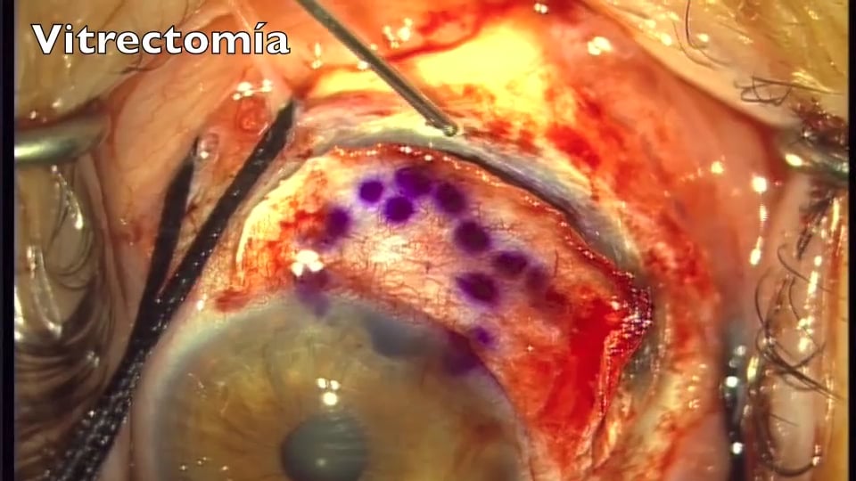 Iridociclectomía de melanoma de iris