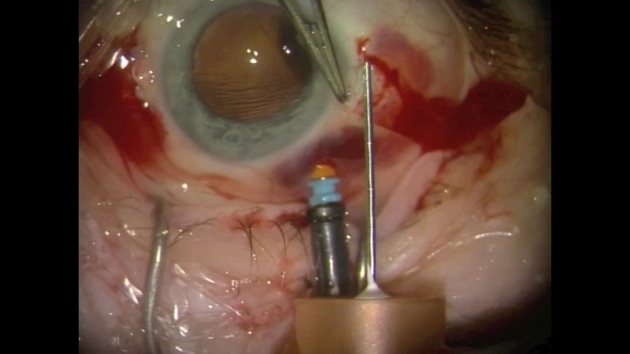 V4-Implantes de lentes en sulcus con hápticos fijados a túnel escleral