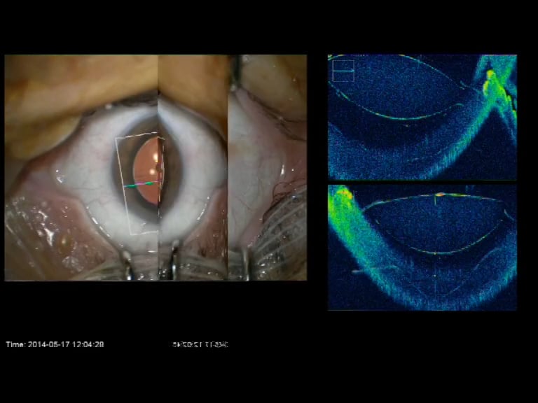 Rescam 700, Cirugía con OCT dinámica intraoperatoria, una nueva era en la Cirugía Oftalmológica