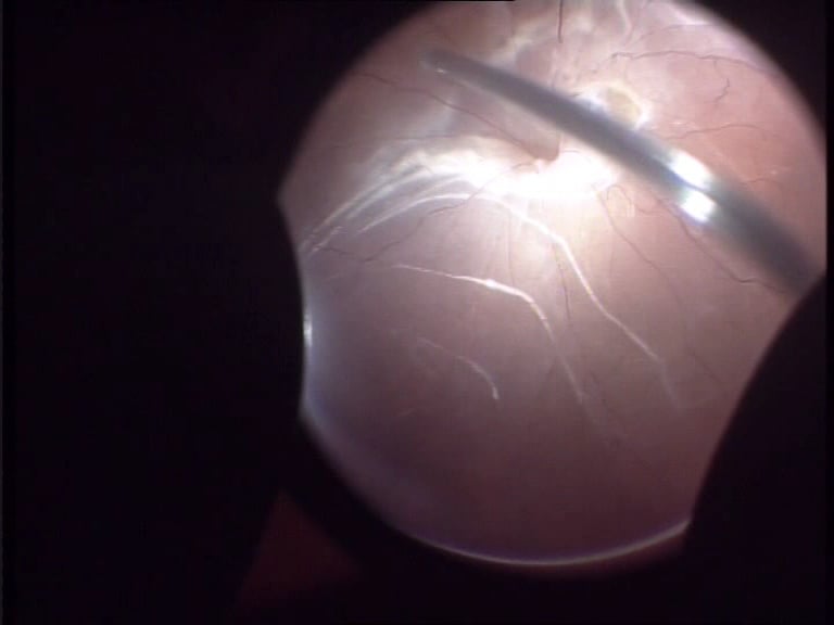 Extracción de cuerdas subretinianas peripapilares