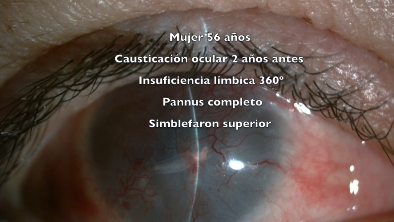 Simple Limbal Epithelial Transplantation (SLET) para la deficiencia total de células de Stem