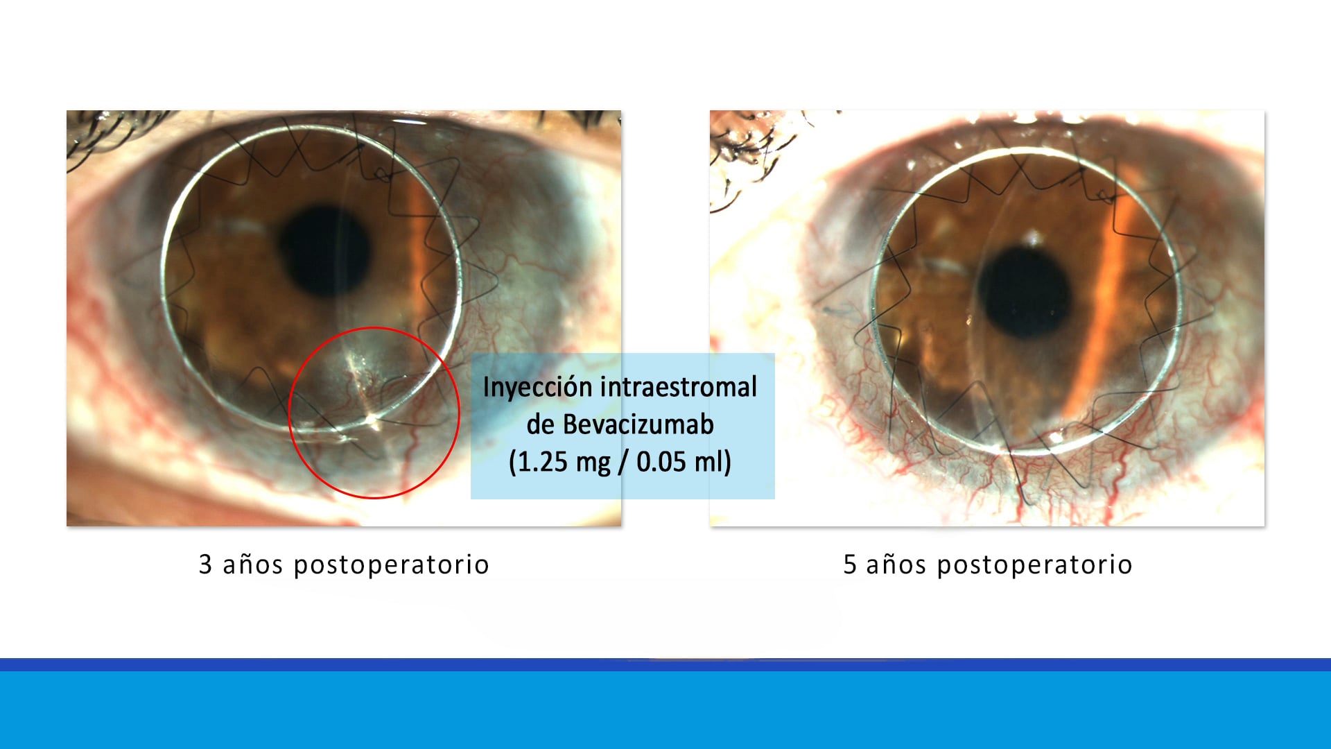 Poniendo límites a la neovascularización corneal: Anillo de Krumeich