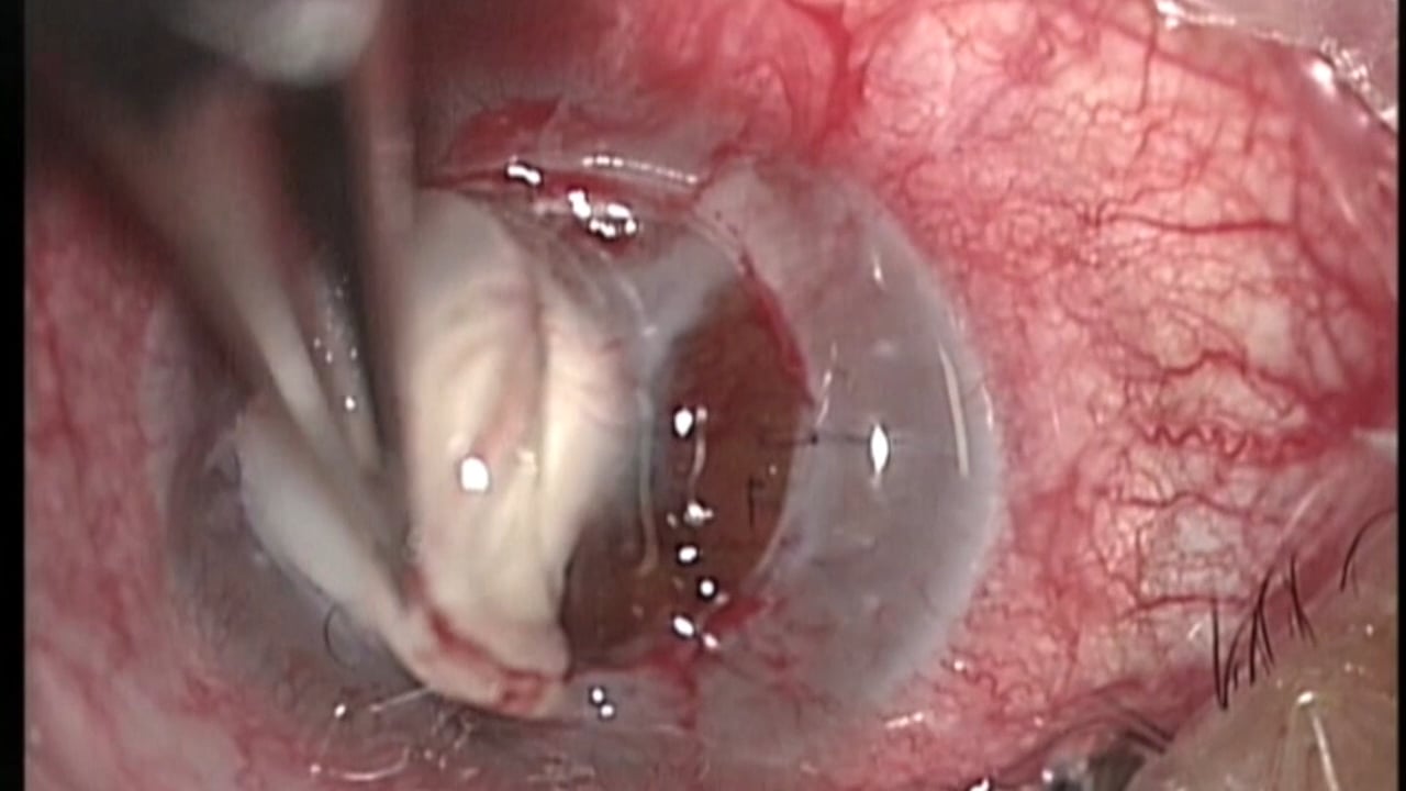 Queratoplastia en caliente y extracción de membranas en una queratitis por fusarium