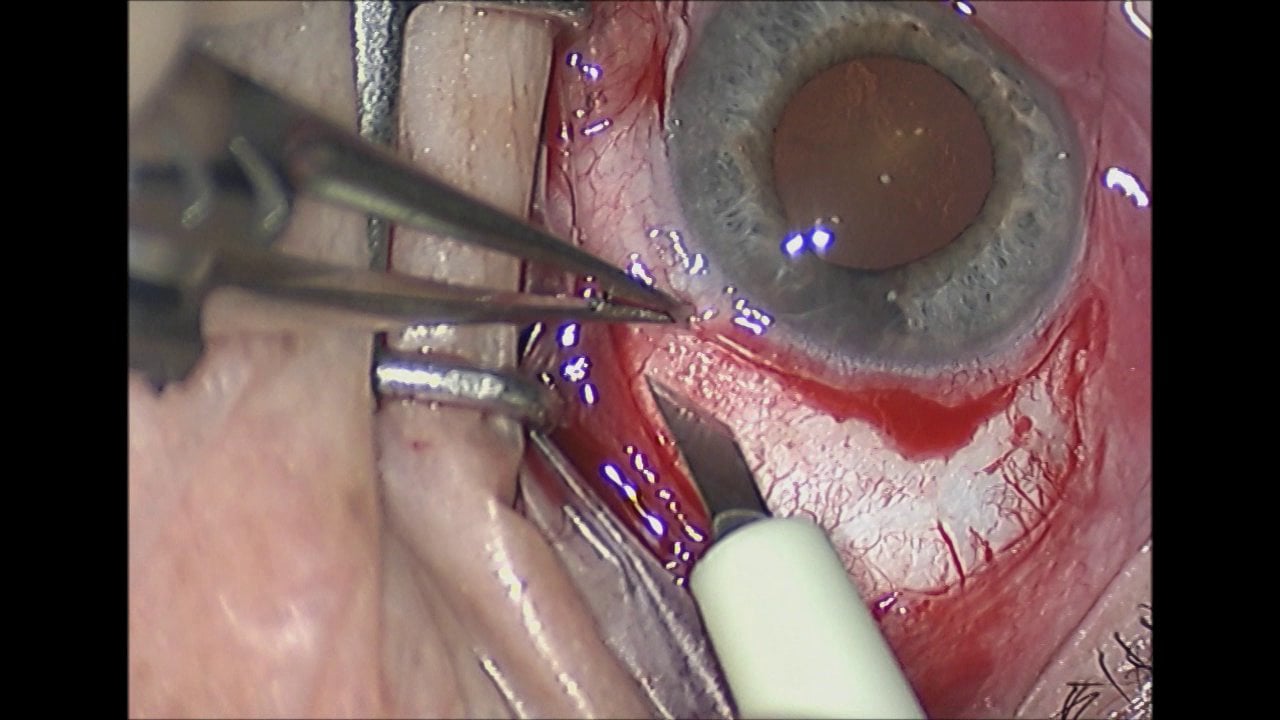 V7-Cirugía combinada mediante extirpación y pupiloplastia en un nevus nevocítico de iris