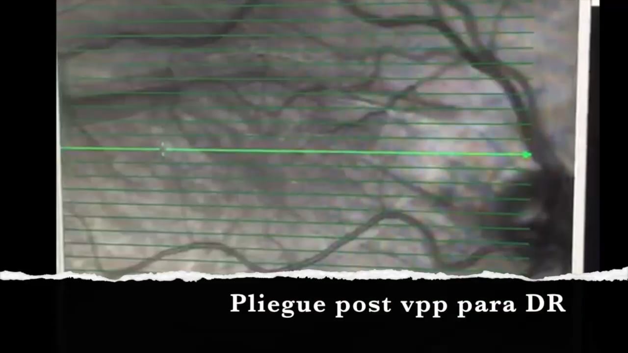 Pliegue macular