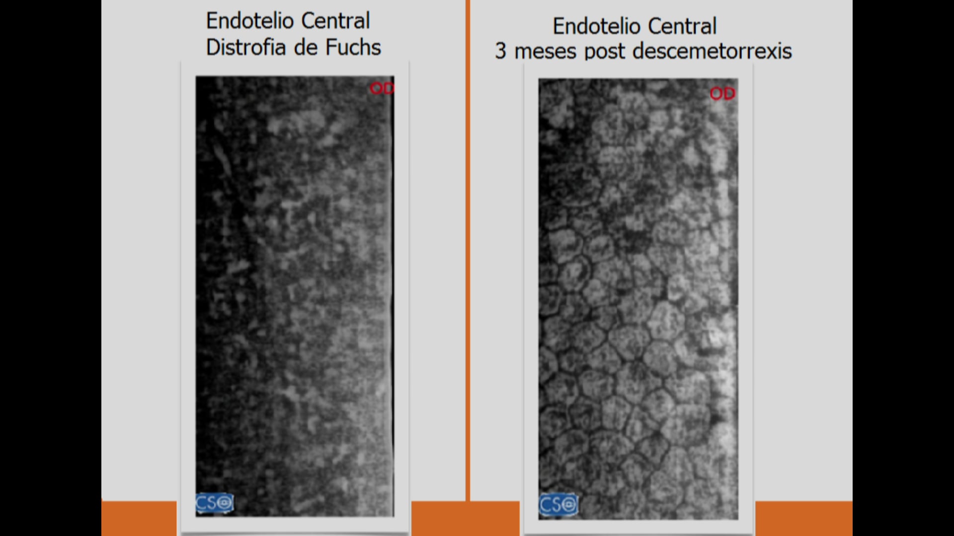 Descemetorrexis sin trasplante de endotelio: Una alternativa al tratamiento de la distrofia de Fuchs