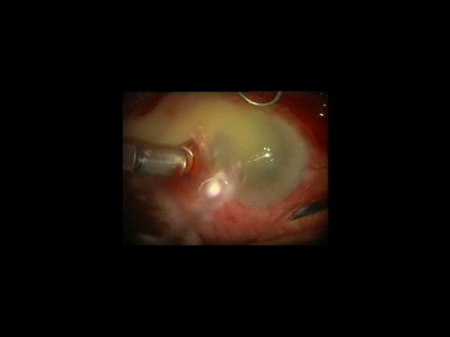 V9-Vitrectomía y drenaje de contenido de cámara vítrea por polo anterior en endoftalmitis al límite